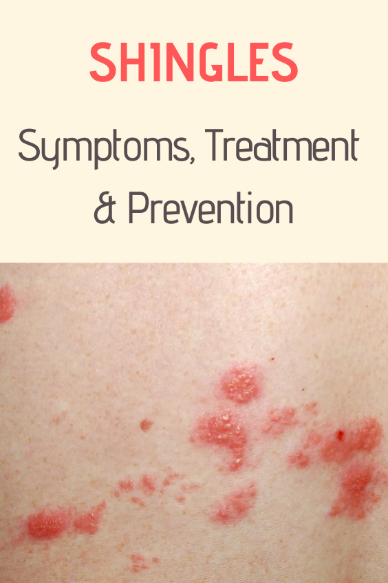 Symptoms And Symptoms Of Shingles