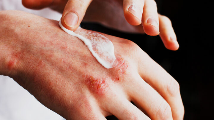 Neurodermatitis (Eczema): Symptoms of The Skin Disease