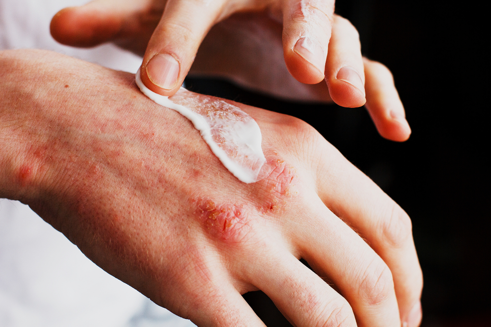 Neurodermatitis (Eczema): Symptoms of The Skin Disease