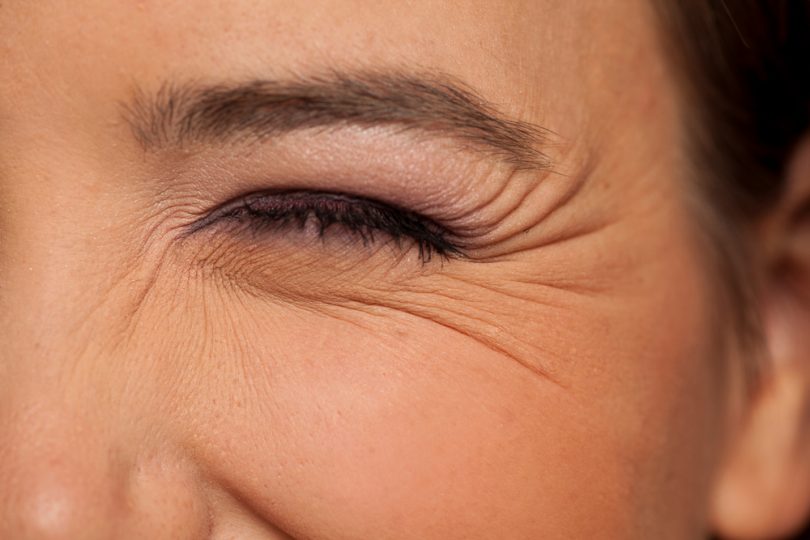 Female Facial Wrinkles Patient Before And After Effect 