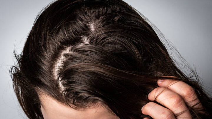 Greasy Hair: Tips to Get Rid of It Quickly