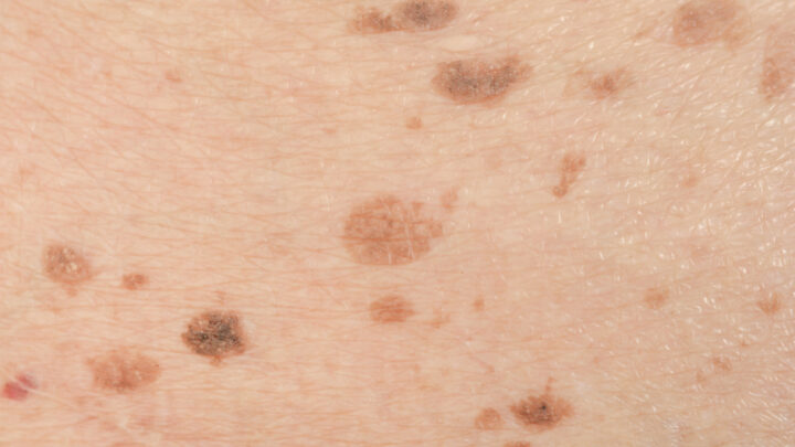 How to Remove Liver Spots and Birthmarks: Procedure and Methods