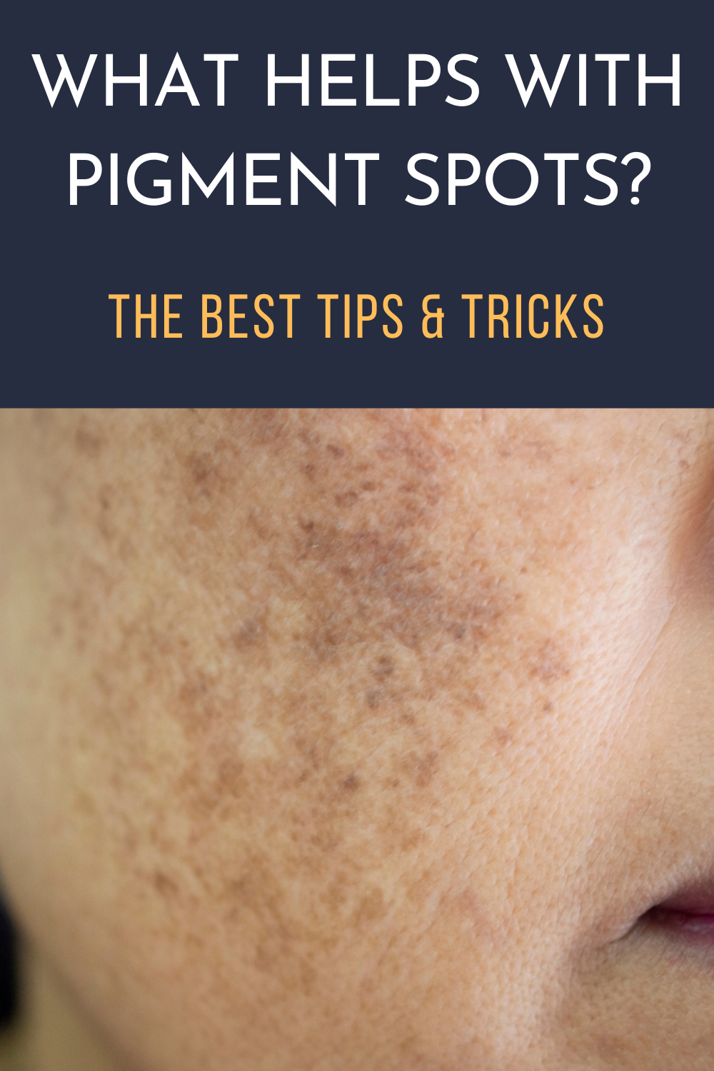 What Helps with Pigment Spots? The Best Tips & Tricks