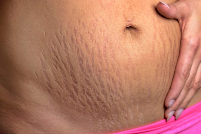 thigh stretch marks thigh stretch marks