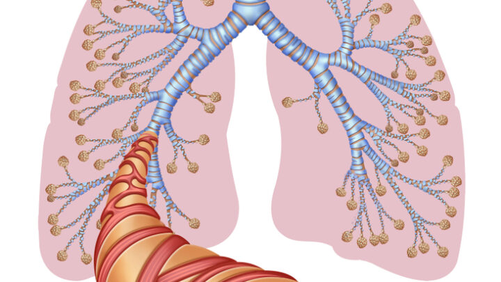 Home Remedies for Bronchitis: The 9 Best Helpers
