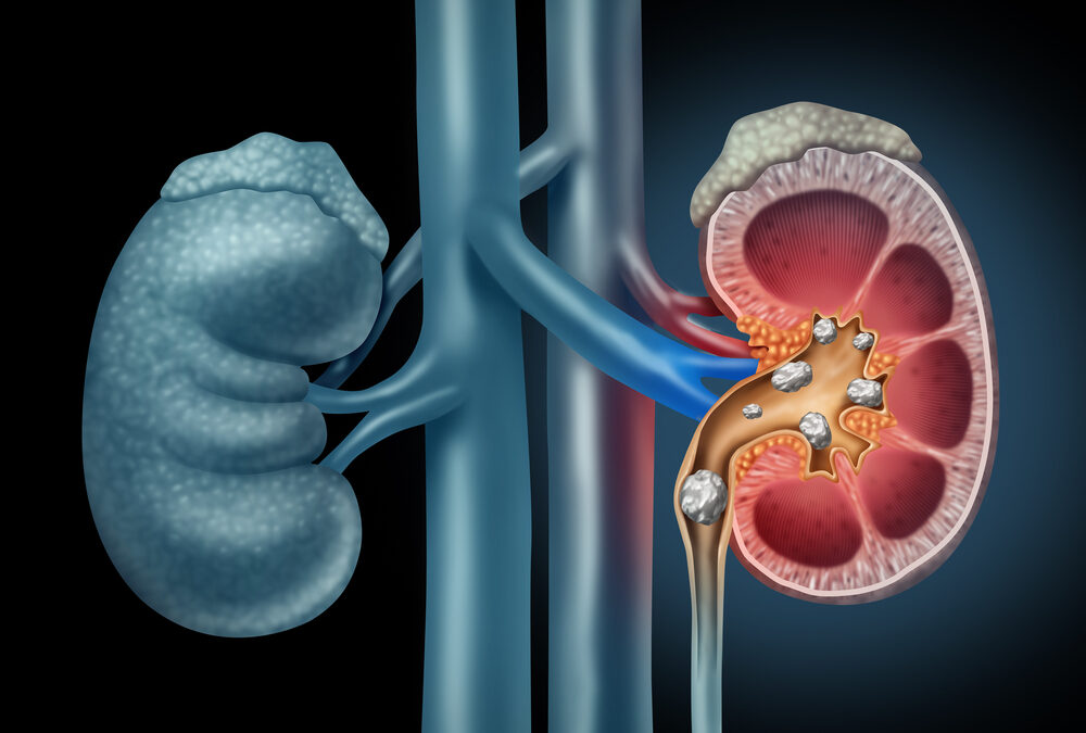 How to Protect Yourself from Kidney Stones: 3 Important Rules