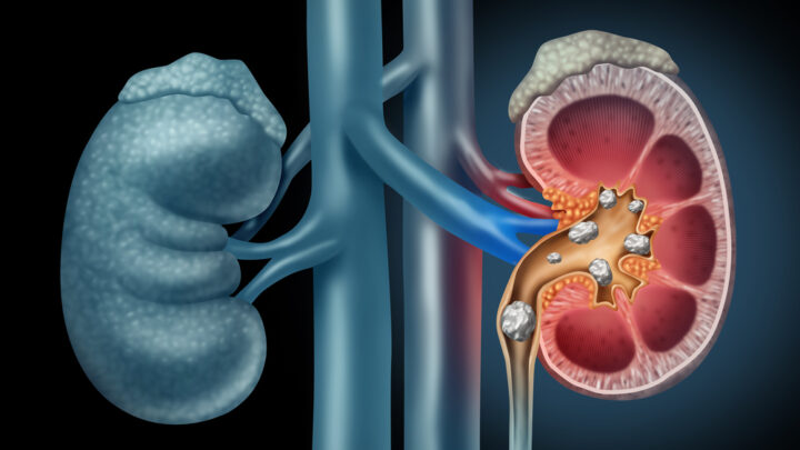 How to Protect Yourself from Kidney Stones: 3 Important Rules