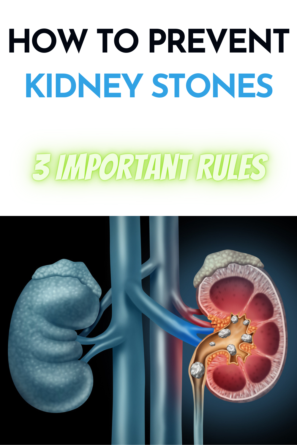 How to Protect Yourself from Kidney Stones: 3 Important Rules