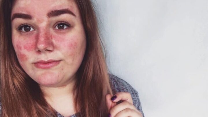 Everything You Need to Know About Psoriasis