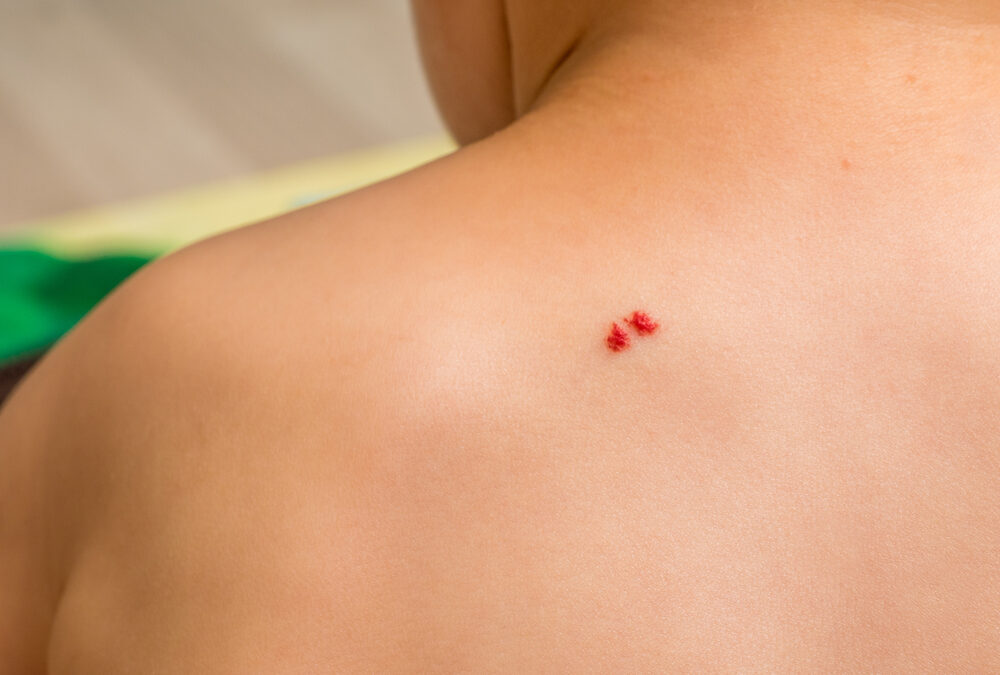 Tardive Hemangiomas: Are The Red Moles Dangerous?