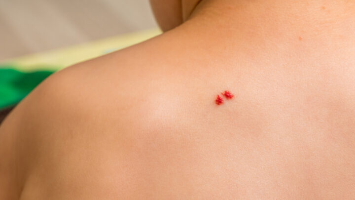 Tardive Hemangiomas: Are The Red Moles Dangerous?