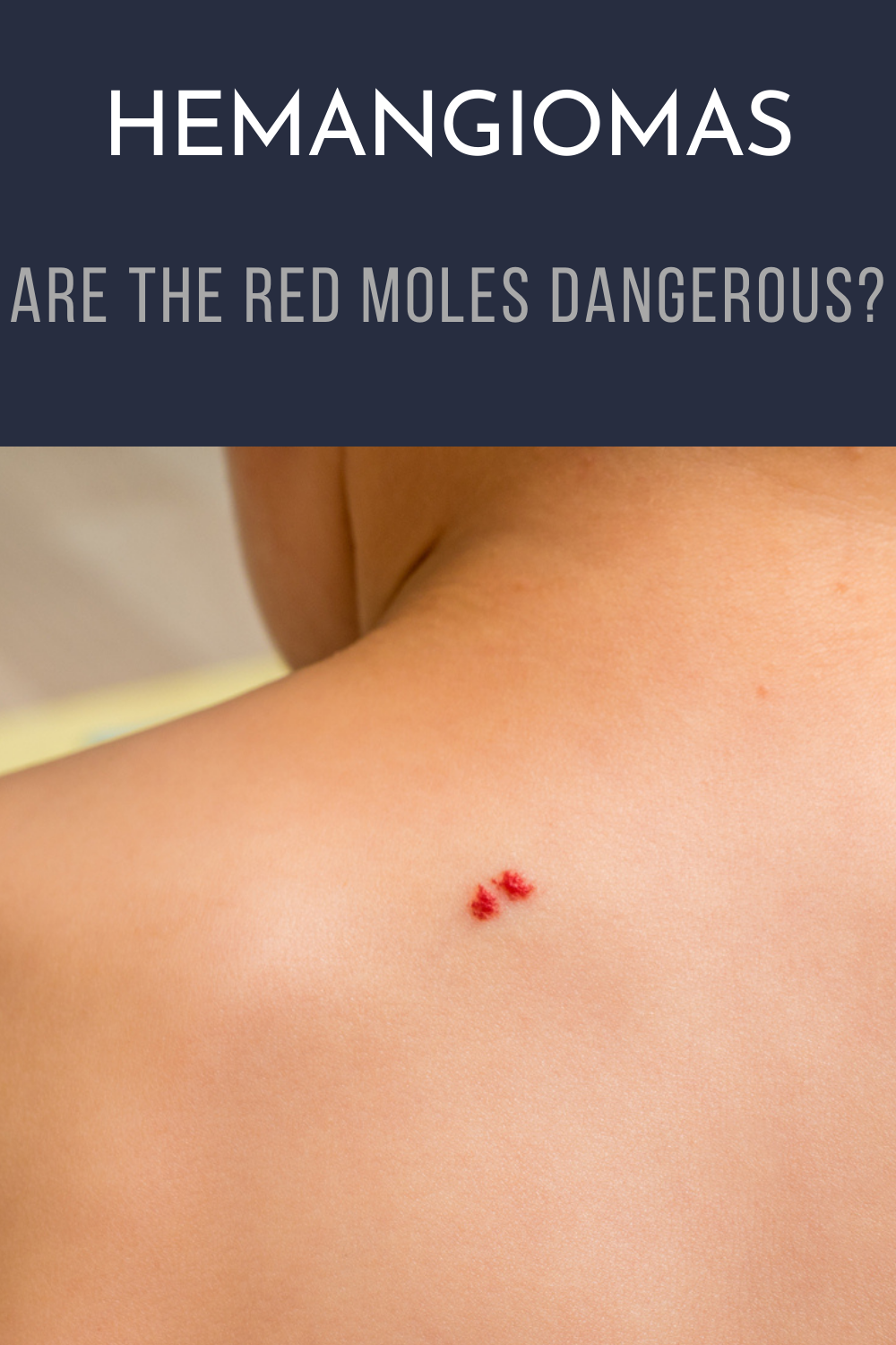 Tardive Hemangiomas: Are The Red Moles Dangerous?