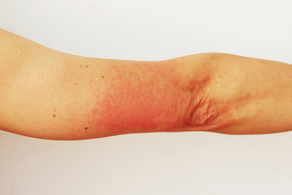 Sun Allergy The Best Tips Against Hives And Itching