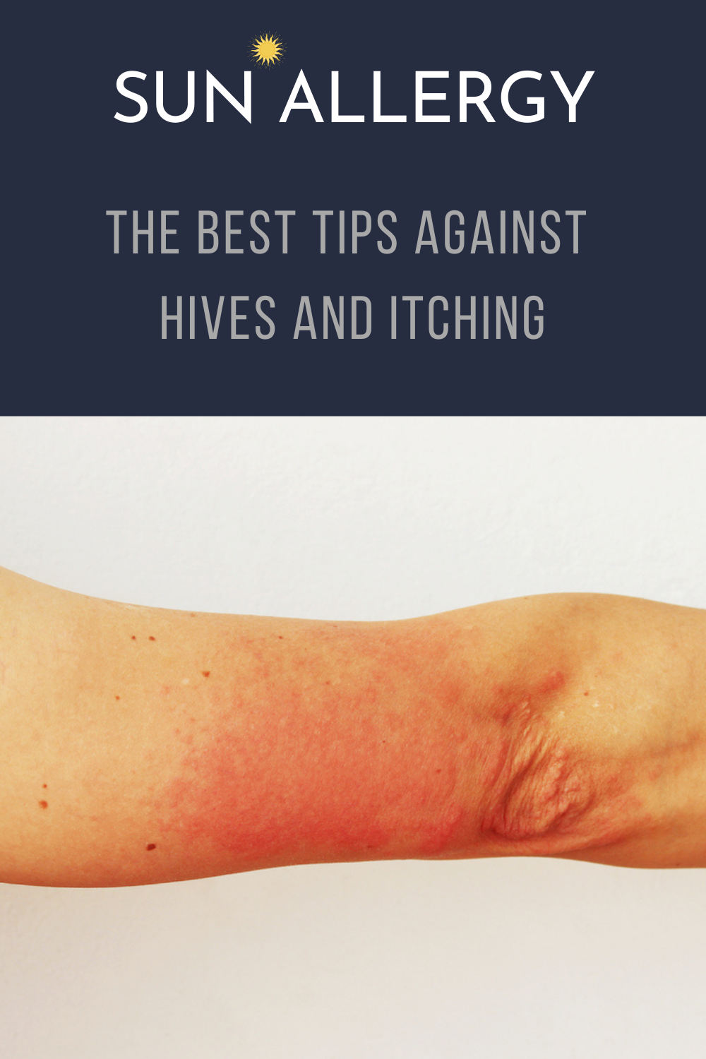 Sun Allergy: The Best Tips Against Hives And Itching