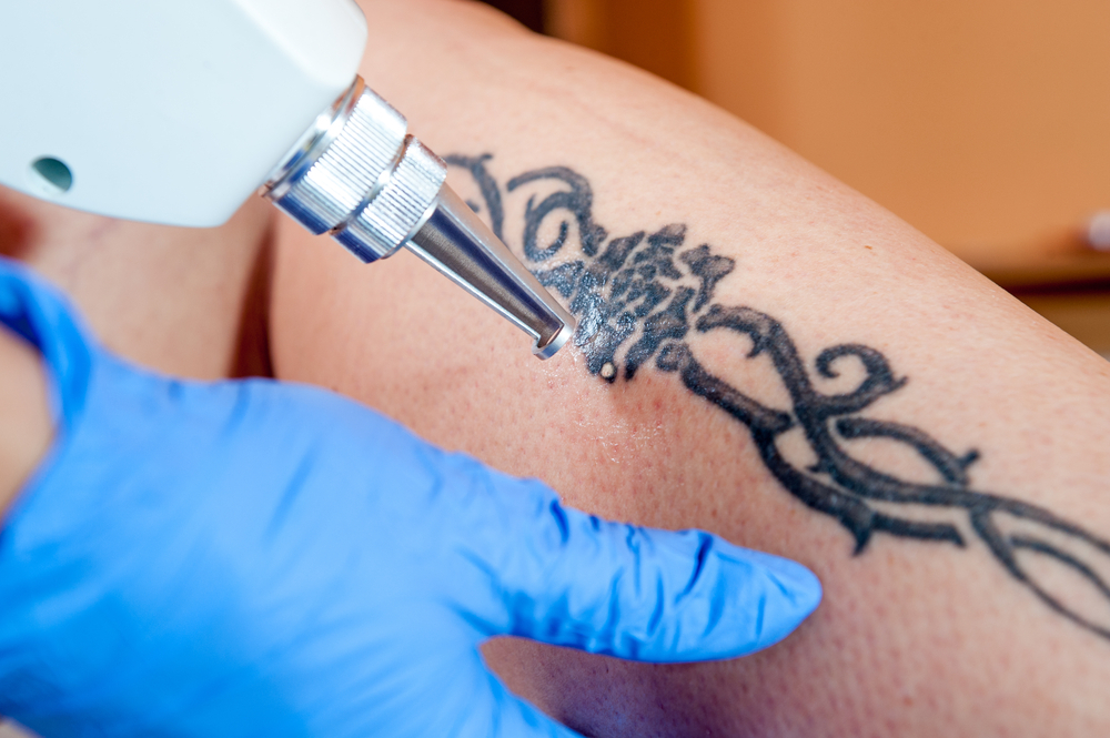tattoo removal 2