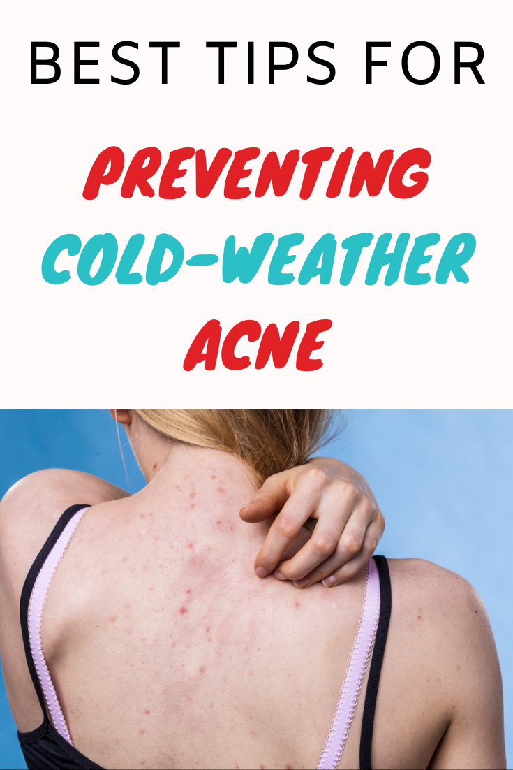 Best Tips for Preventing ColdWeather Acne