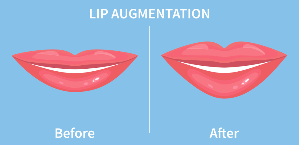 Before after lip augmentation