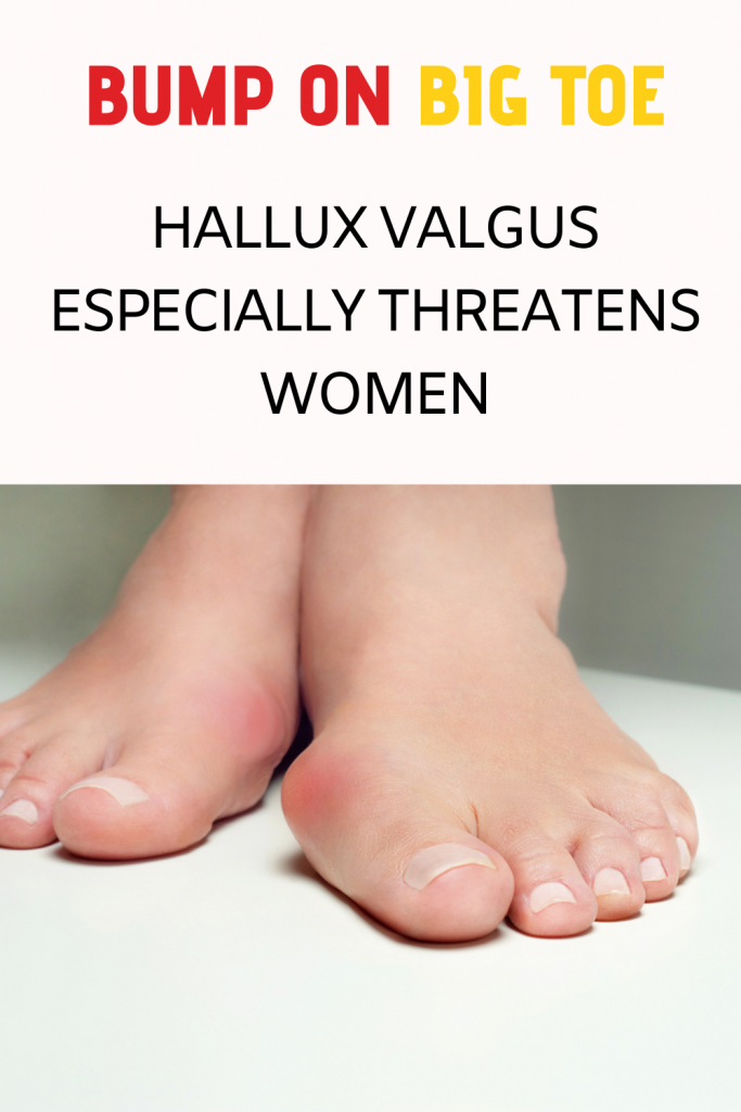 bump-on-big-toe-hallux-valgus-especially-threatens-women-women-s