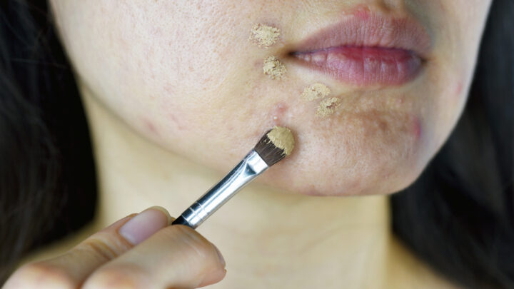 How to Hide Acne Scars with Makeup
