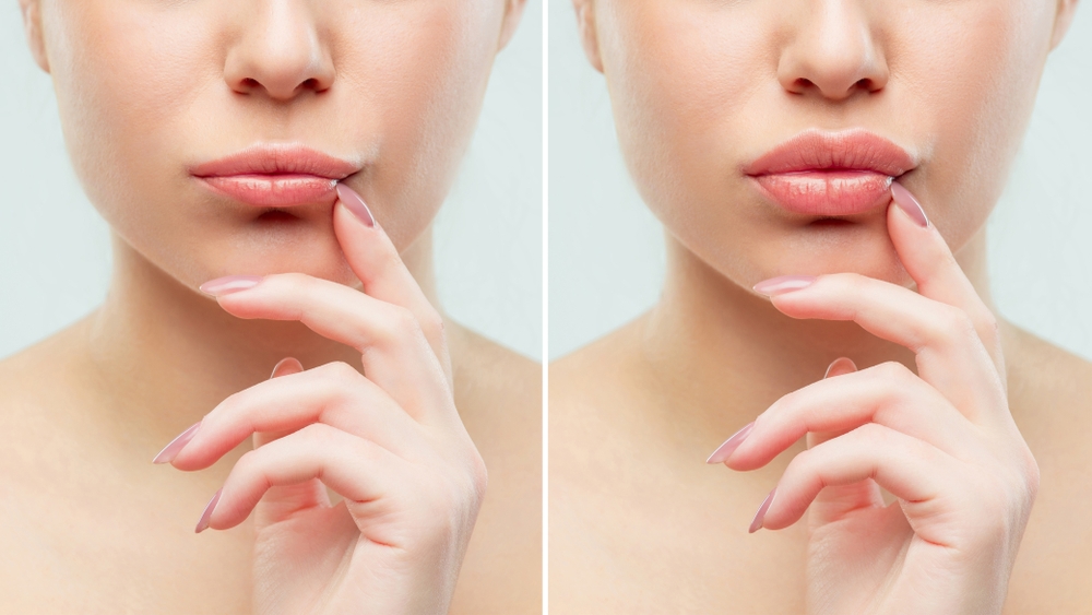 lip augmentation facts