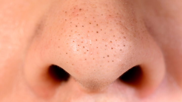 8 Natural Home Remedies to Get Rid of Blackheads