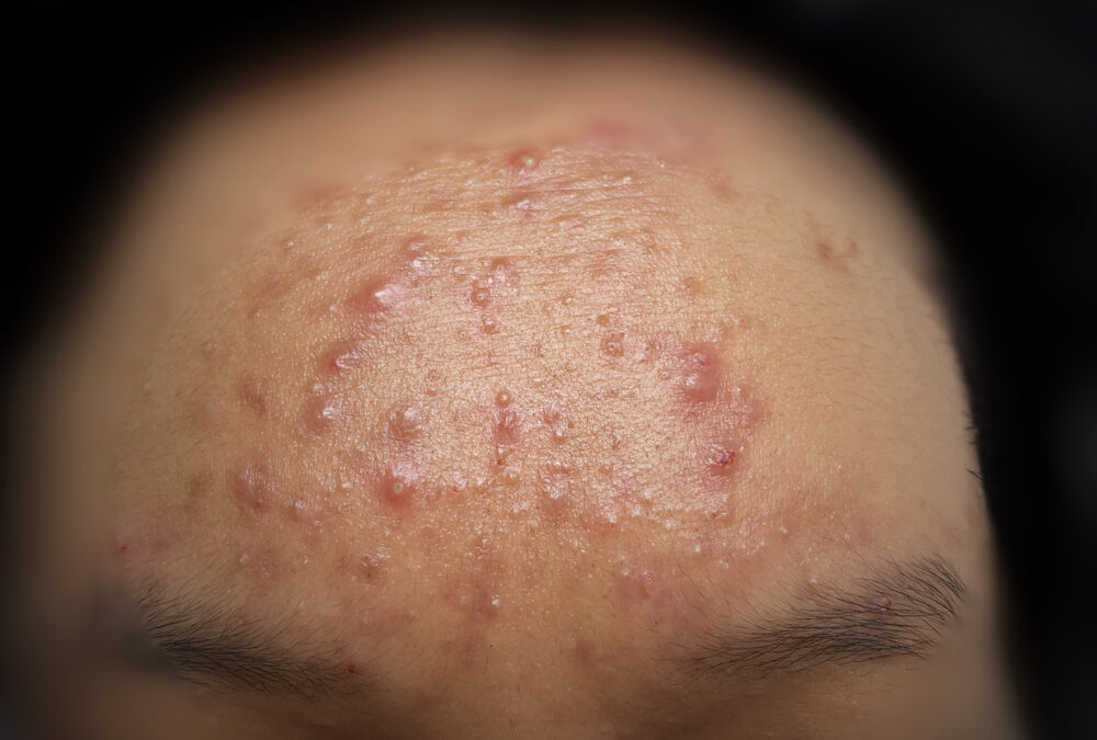 Cystic Acne Home Remedies: 5 Treatments to Try