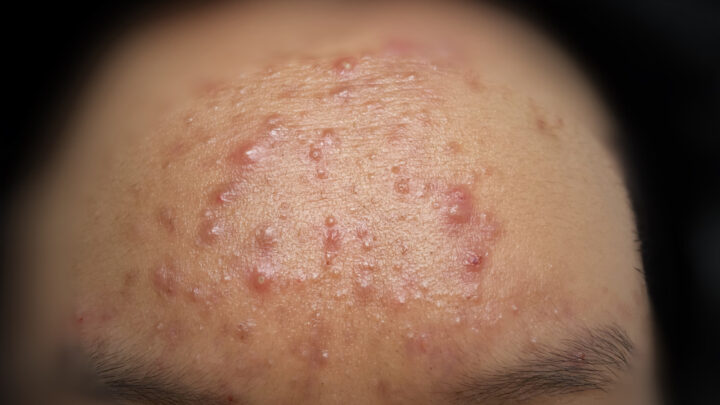 Cystic Acne Home Remedies: 5 Treatments to Try