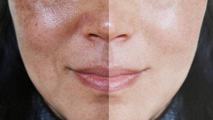 5 Natural Ways to Minimize or Shrink Pores