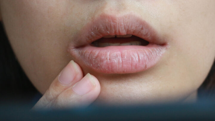 8 Natural Remedies to Get Rid of Cracked Lips