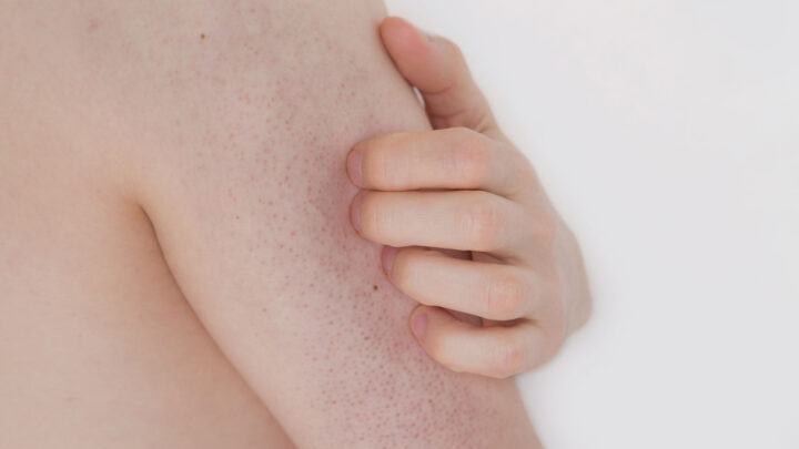 Red Dots on Your Arm? That’s What It’s All About!