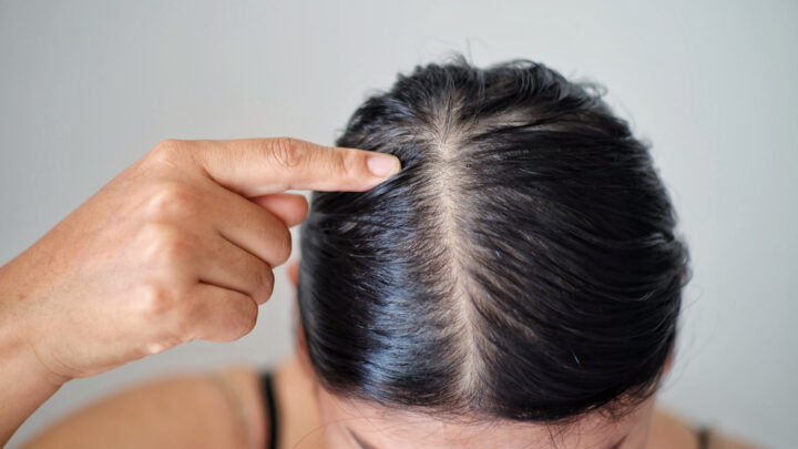 Oily Hair Remedy: How to Get Rid of Greasy Hair