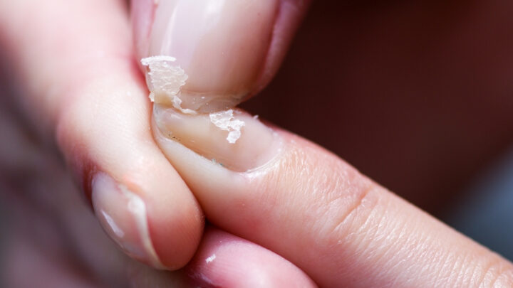 Brittle Nails: Causes, Treatment and Home Remedies