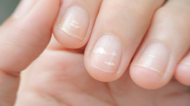 White Spots on the Nails: Causes and More