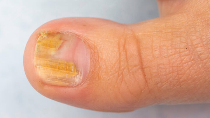 5 Causes of Yellow Nails