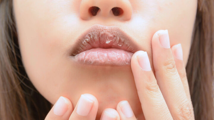 7 Ways to Heal Dry and Chapped Lips