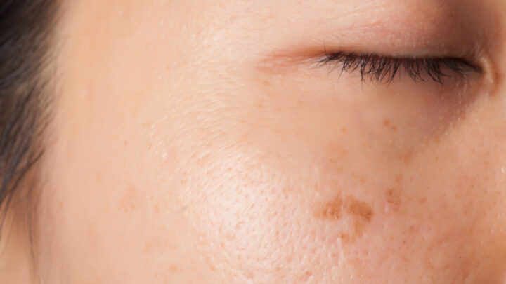 All Types of Skin Spots and How to Treat Them