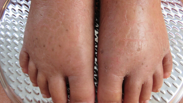 9 Simple Ways to Reduce Water Retention (Edema)