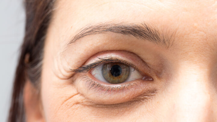 How to Get Rid of Bags Under Eyes