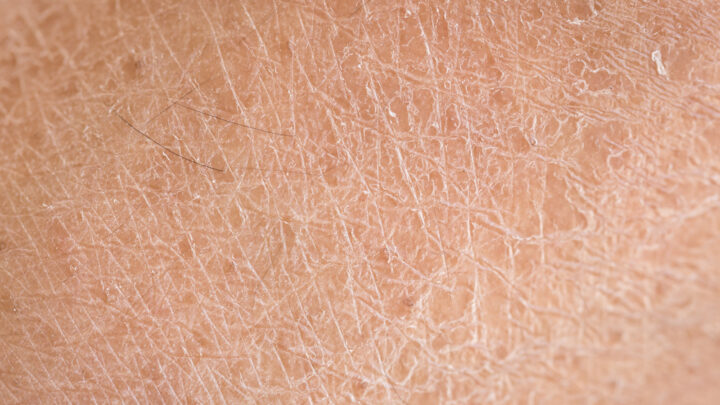 5 Ways to Deal with Dry Skin