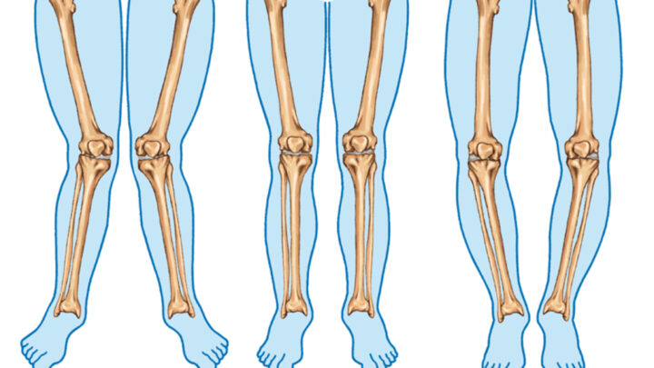 How to Fix Bowlegs (Bandy Legs) in Adults