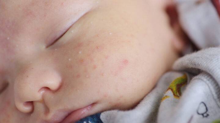 Baby Acne: Causes, Symptoms and Treatment