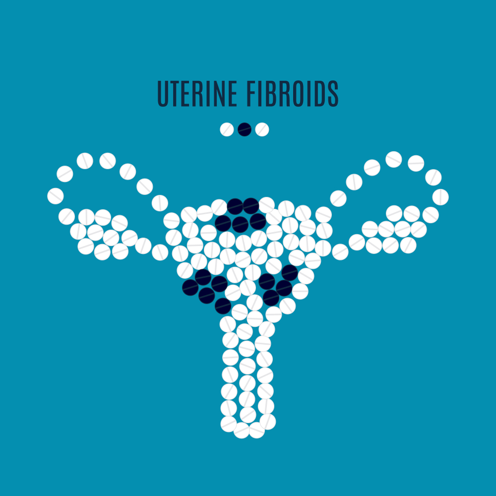 6 Health Problems Caused by Uterine Fibroids