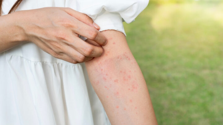 How to Treat a Stress Rash
