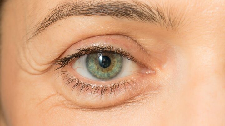 How to Get Rid of Puffy Eyes From Crying