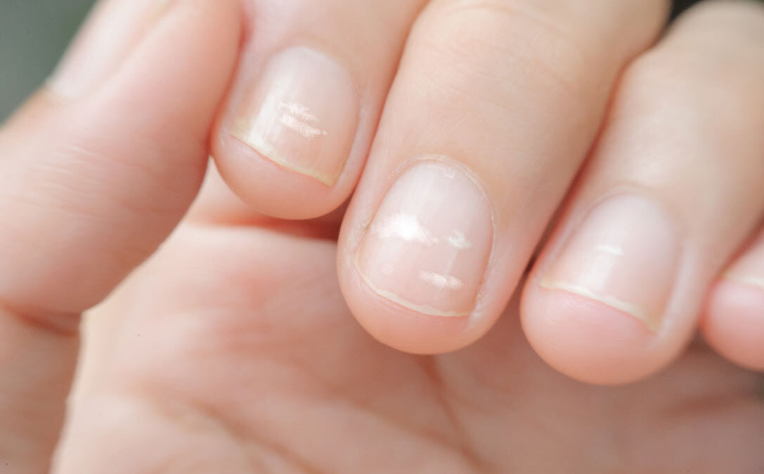What’s Causing White Spots on Your Nails?