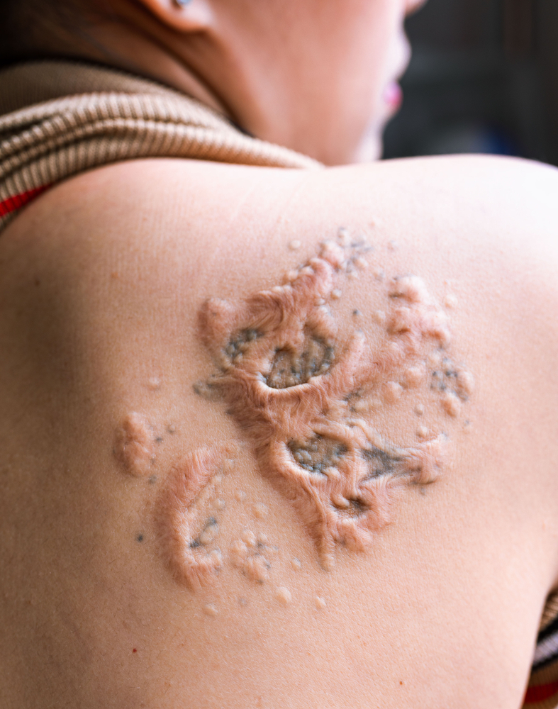 The Ultimate Guide To Dealing With Tattoo Rashes