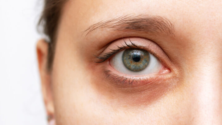How To Use Castor Oil For Dark Circles