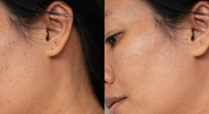 12 Effective Home Remedies to Get Rid of Dark Spots on Your Skin