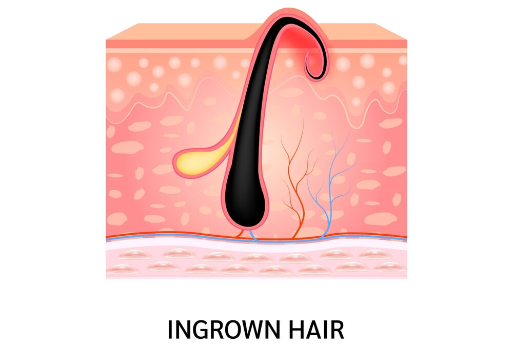 Prevent Painful Ingrown Hairs: DIY Coffee Body Scrub for Smooth Skin