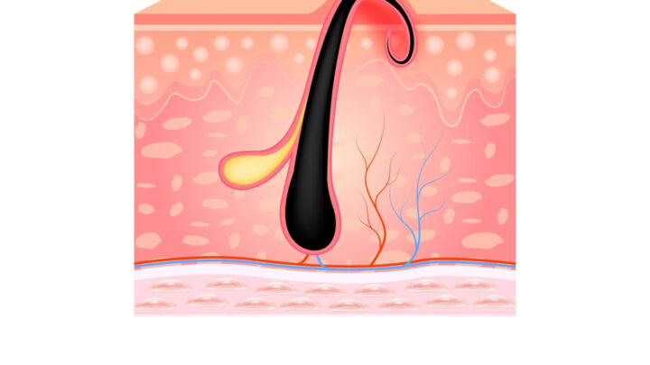 Prevent Painful Ingrown Hairs: DIY Coffee Body Scrub for Smooth Skin
